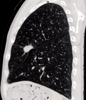 Sagittal Plane — Pulmonary Nodule in the Left Upper Lobe Sagittal Plane — Pulmonary Nodule in the Left Upper Lobe