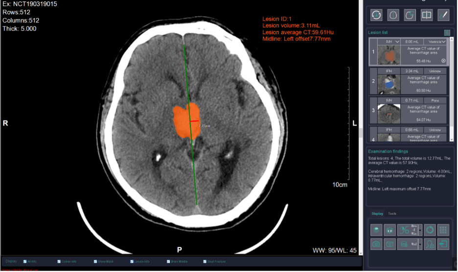 acute-intracerebral-hemorrhage-ct-scan-with-measurements acute-intracerebral-hemorrhage-ct-scan-with-measurements