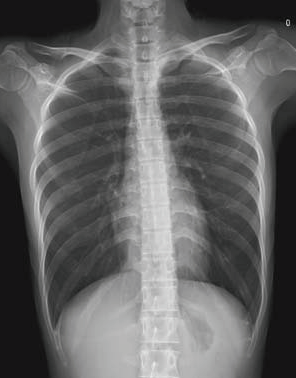 normal-pa-chest-x-ray-lungs normal-pa-chest-x-ray-lungs