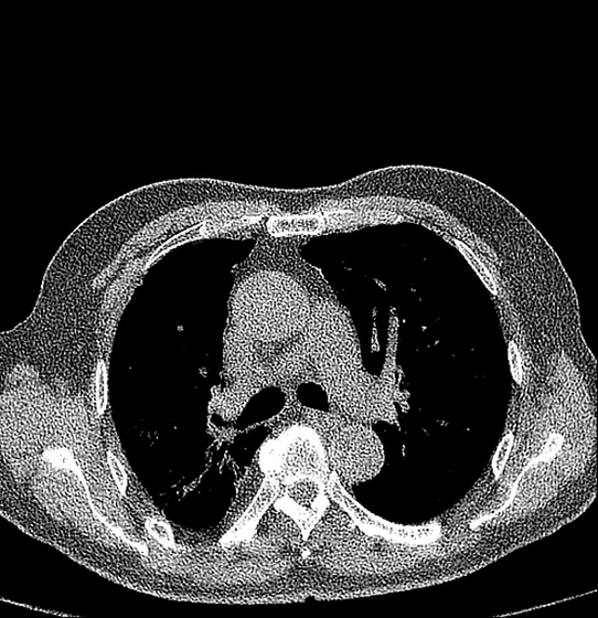 CT Scan Image of Ultra-Low Dose Lung Screening (1) CT Scan Image of Ultra-Low Dose Lung Screening (1)