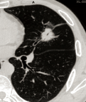 Axial Plane — Pulmonary Nodule in the Left Upper Lobe Axial Plane — Pulmonary Nodule in the Left Upper Lobe