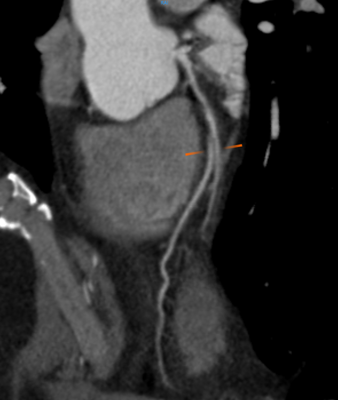 CT Angiography (CTA) Scan of the Coronary Artery (1) CT Angiography (CTA) Scan of the Coronary Artery (1)