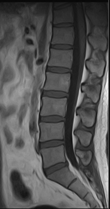 Sagittal MRI scan of the lumbar spine Sagittal MRI scan of the lumbar spine