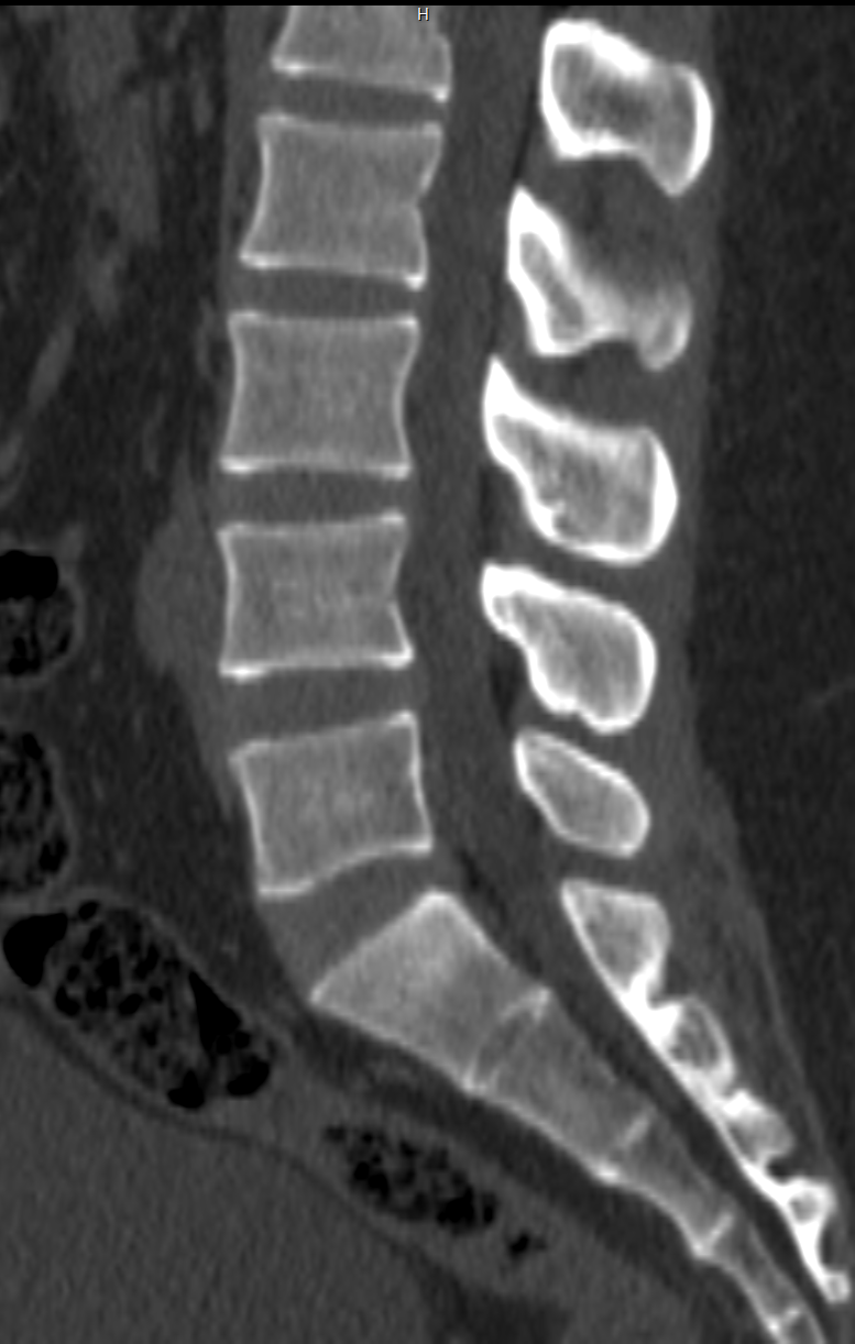 Sagittal CT scan of the lumbar spine Sagittal CT scan of the lumbar spine