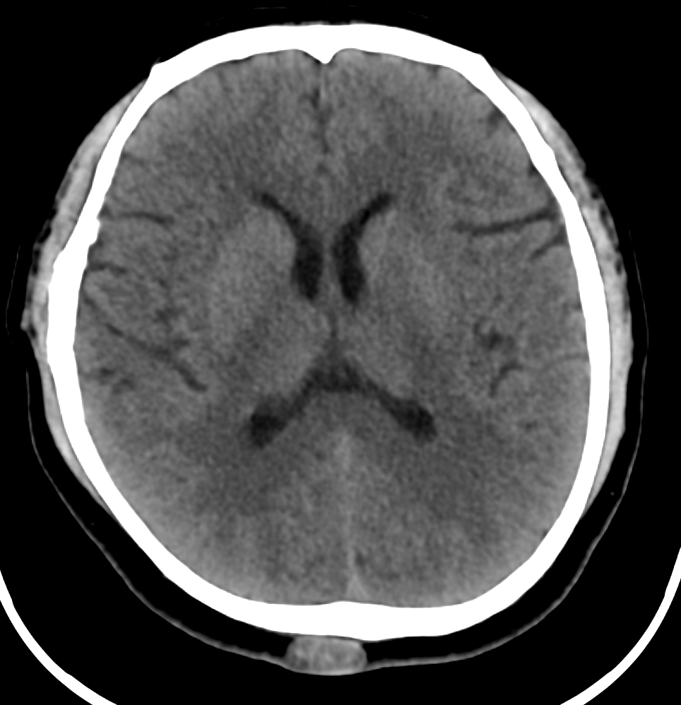 Axial CT scan of a human head in grayscale
