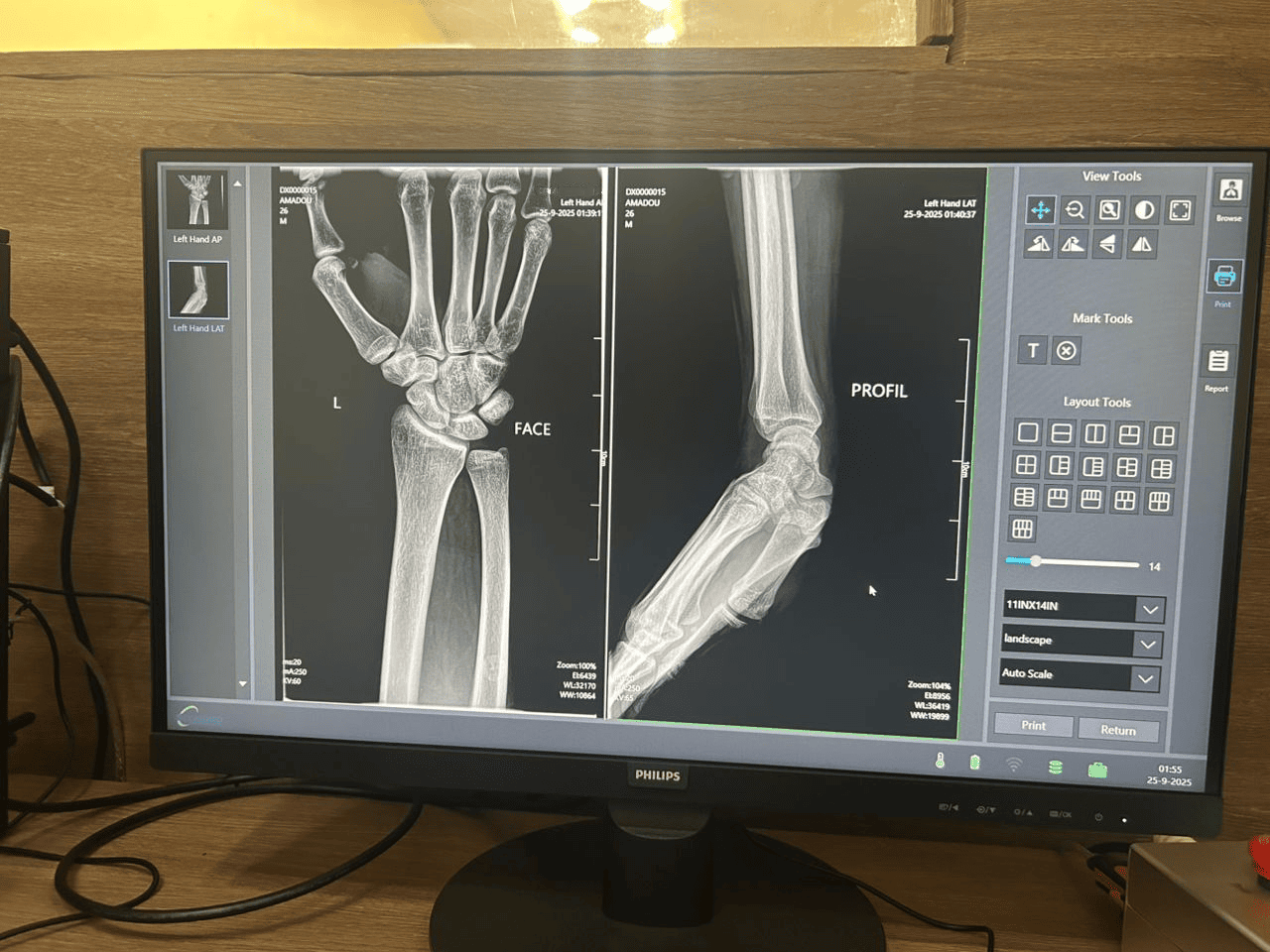 En diagnostisk testskanning med h&oslash;y klarhet utf&oslash;rt av Michael i Niger, som viser den overlegne bildeoppl&oslash;sningen og programvarekalibreringen til r&oslash;ntgensystemet MX-DR500A10.