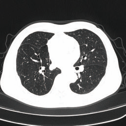 Lung imaging from a CT scan machine