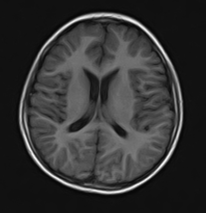 Close-up axial MRI scan of a human brain Close-up axial MRI scan of a human brain