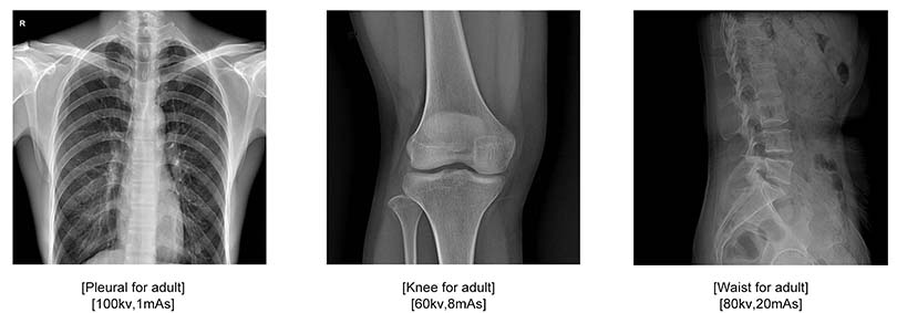 32KW Digital Mobile X-ray Machine images