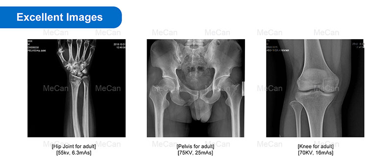 Excellent Images of Digital Mobile Radiography MX-DR056A14