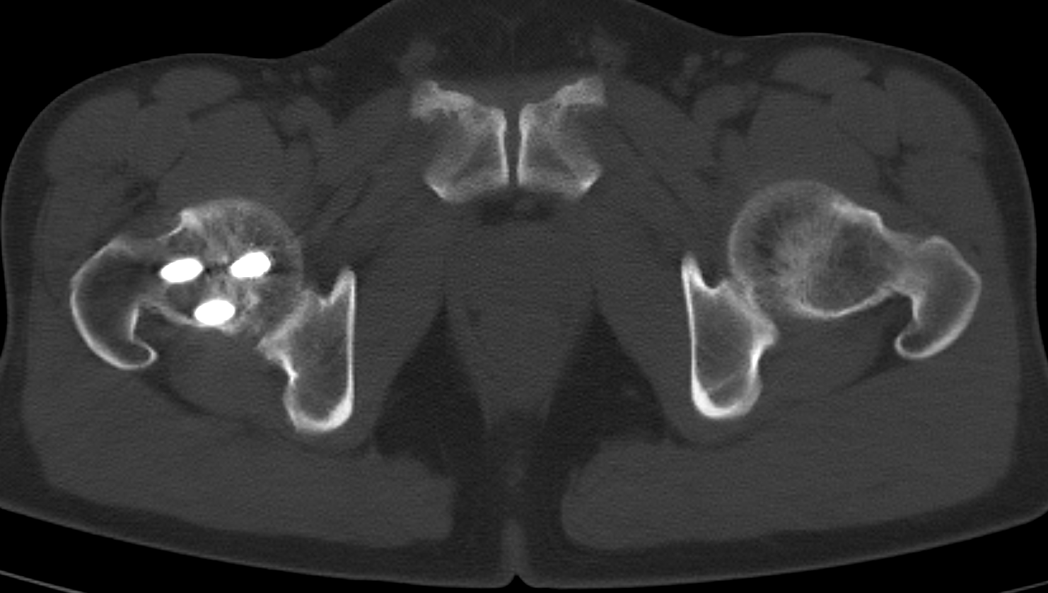 CT Scan Image of Hip Joints CT Scan Image of Hip Joints