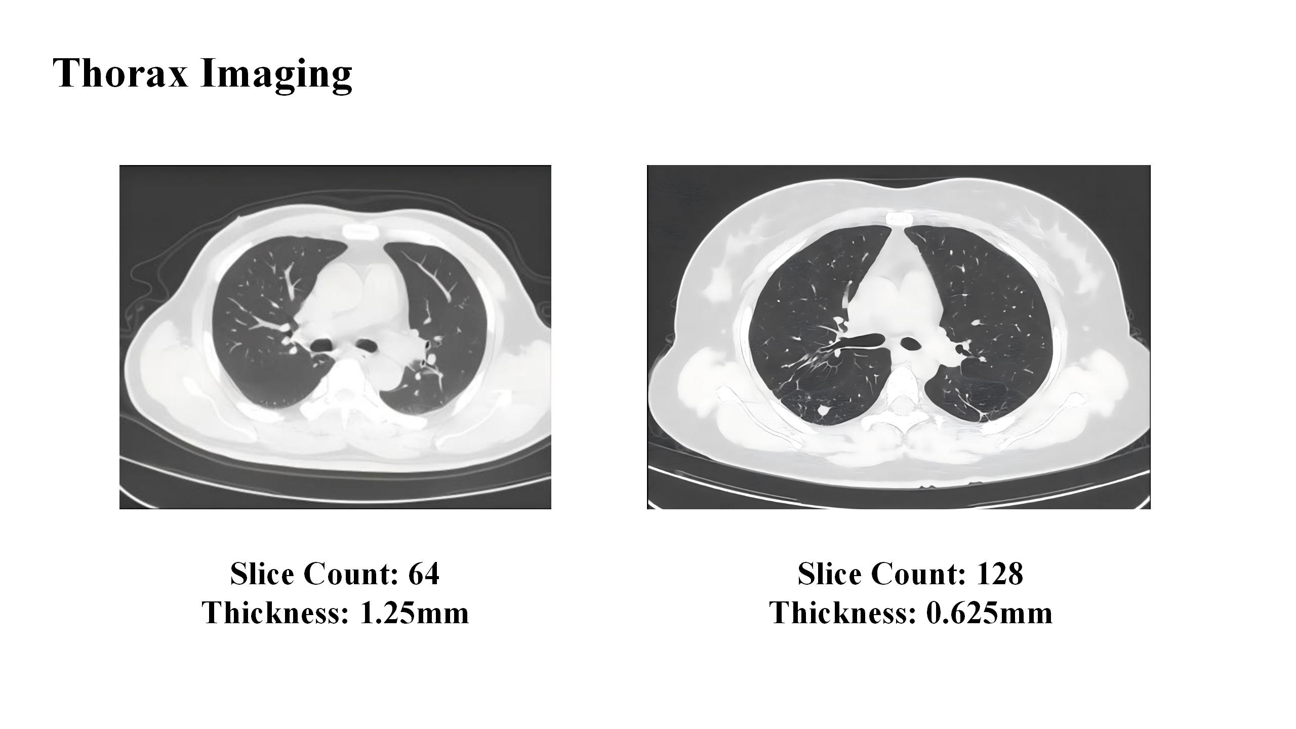 Comparison of Chest CT Image：64-Slice (1.25mm) vs. 128-Slice (0.625mm)