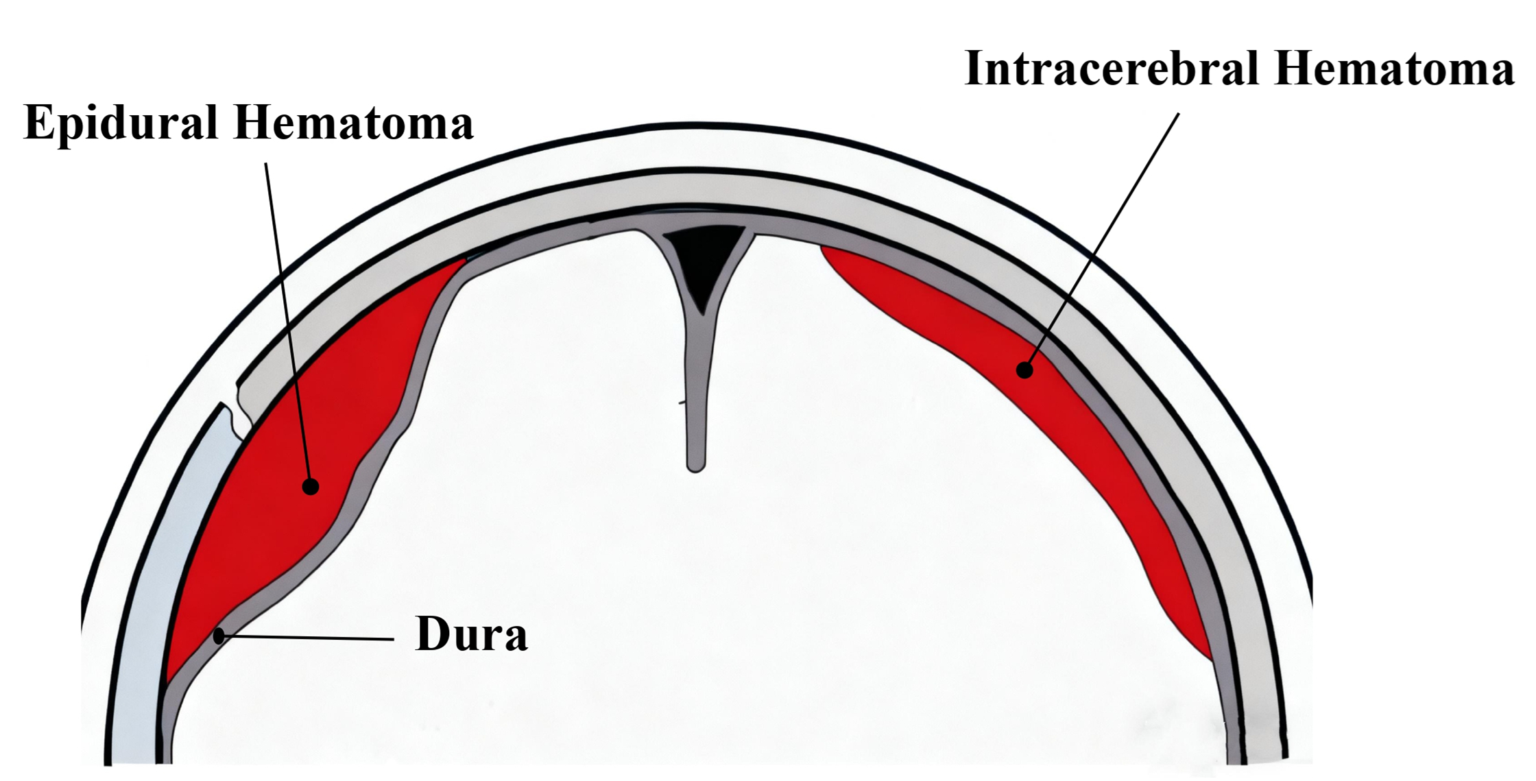 epidural-vs-intracerebral-hematoma-location-diagram