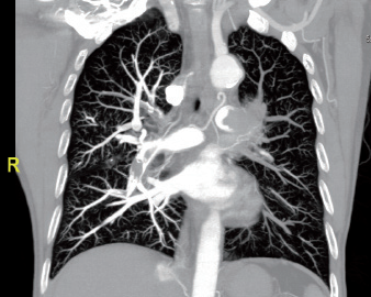 Diagnostic Imaging of a Pulmonary Embolism