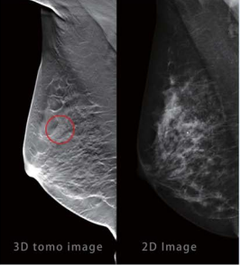 3D Digital Mammography Tomosynthesis Machina