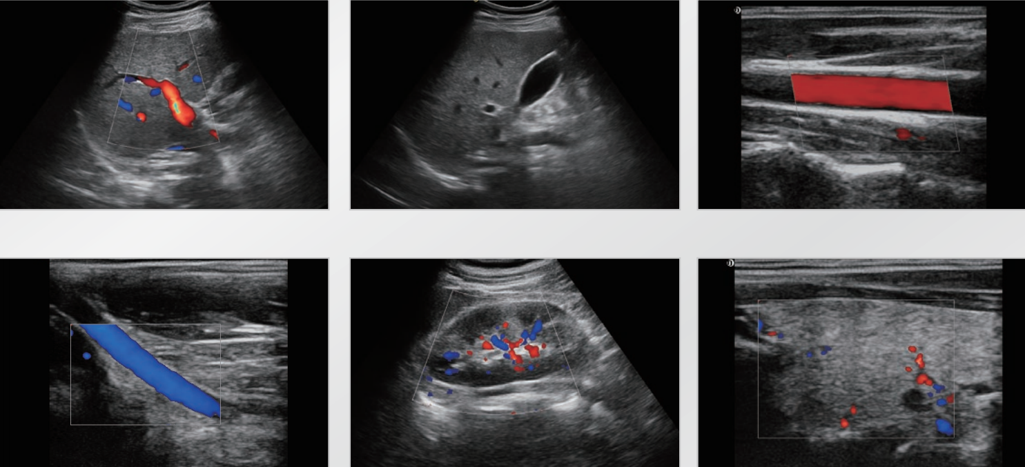 color doppler ultrasound
