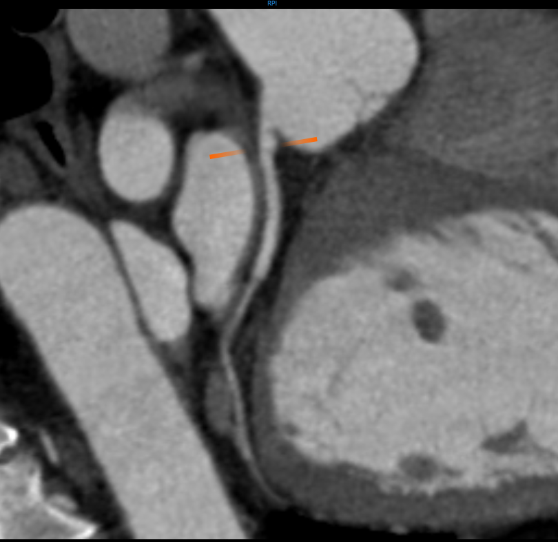 CT Angiography (CTA) Scan of the Coronary Artery (2)