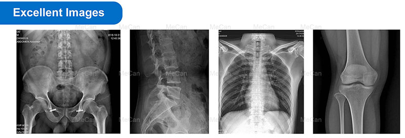 Excellent Images of 32-65KW medical x ray machine Excellent Images of 32-65KW medical x ray machine