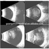 Hordozható AB szkenner: szemészeti ultrahangos képalkotás