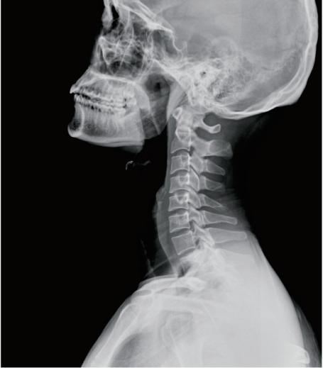 Lateral cervical spine X-ray image showing clear bone structures in digital radiography.