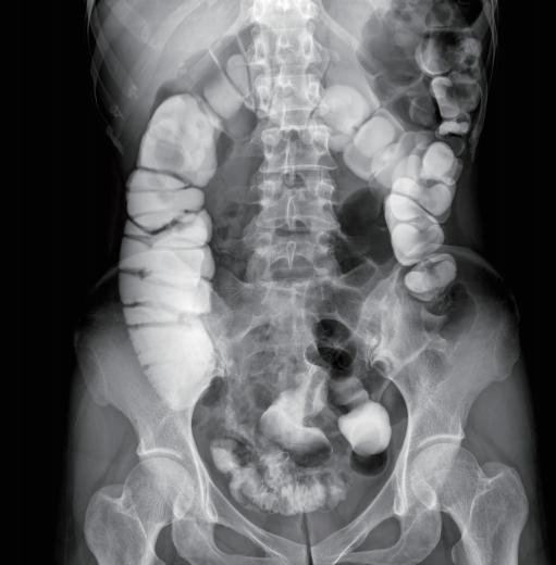 Abdominal contrast X-ray image showing gastrointestinal anatomy during a contrast examination.