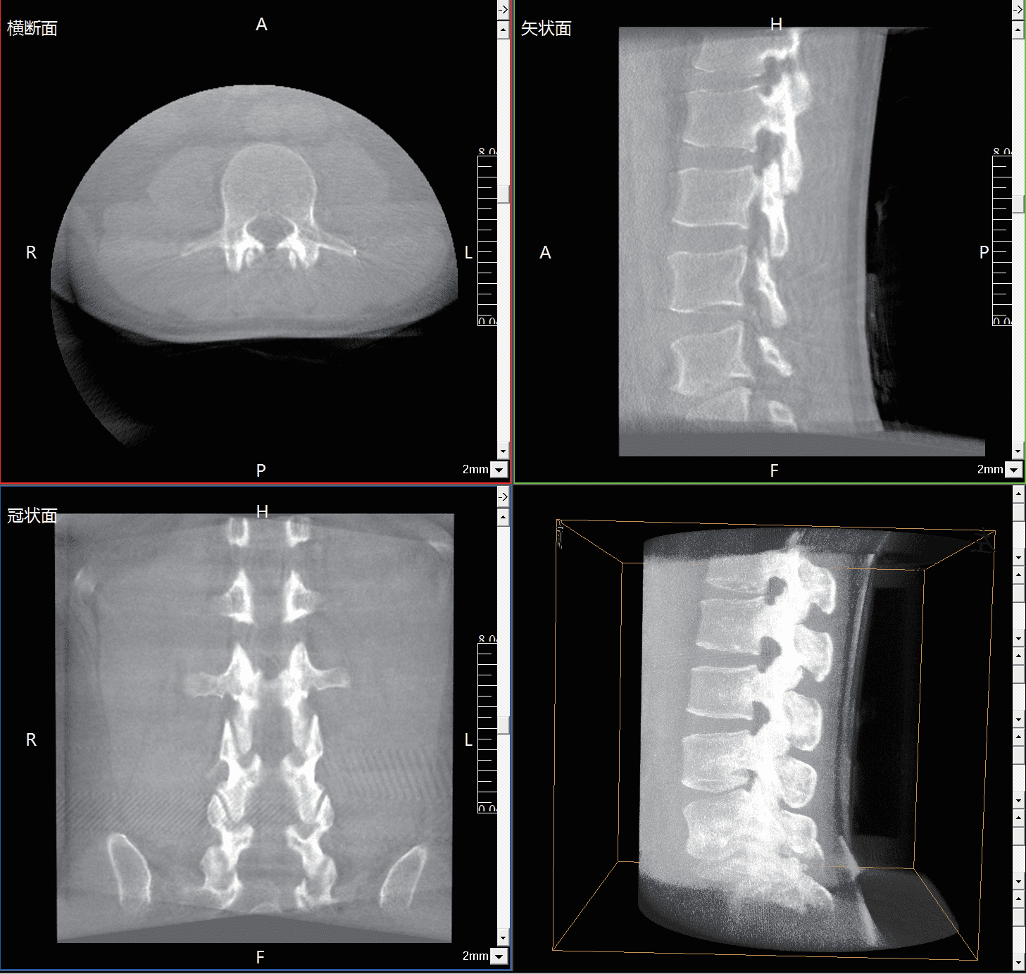 Multiple lumbar vertebrae displayed within a single 3D image using the large field of view of the MCI0423 C-arm.