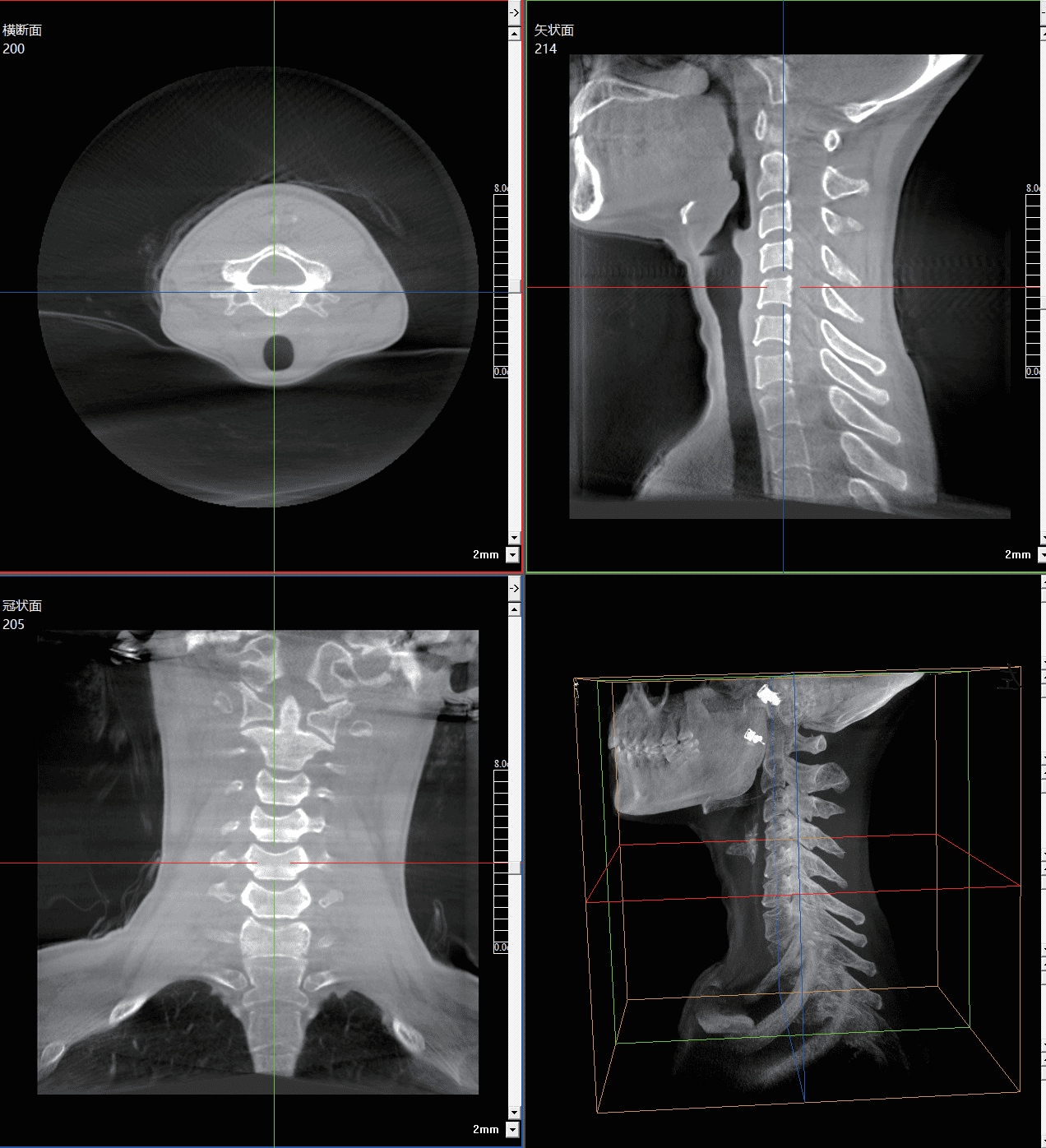 Cervical vertebrae shown in axial, sagittal, coronal, and 3D reconstructed views from the MCI0423 C-arm.