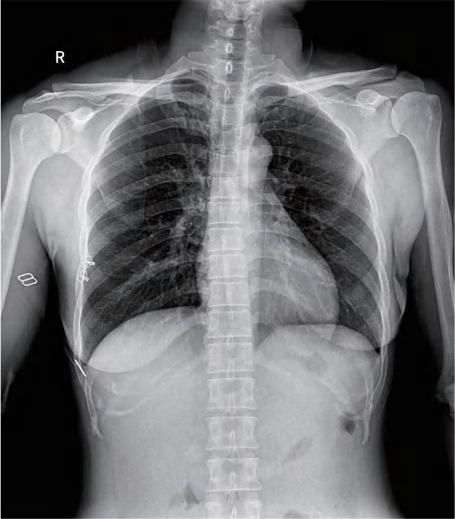 Frontal chest X-ray image showing the lungs, ribs and thoracic structures in digital radiography.