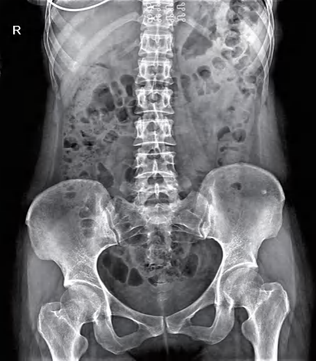 Frontal abdomen and pelvis X-ray image showing lumbar spine, pelvic and abdominal structures.