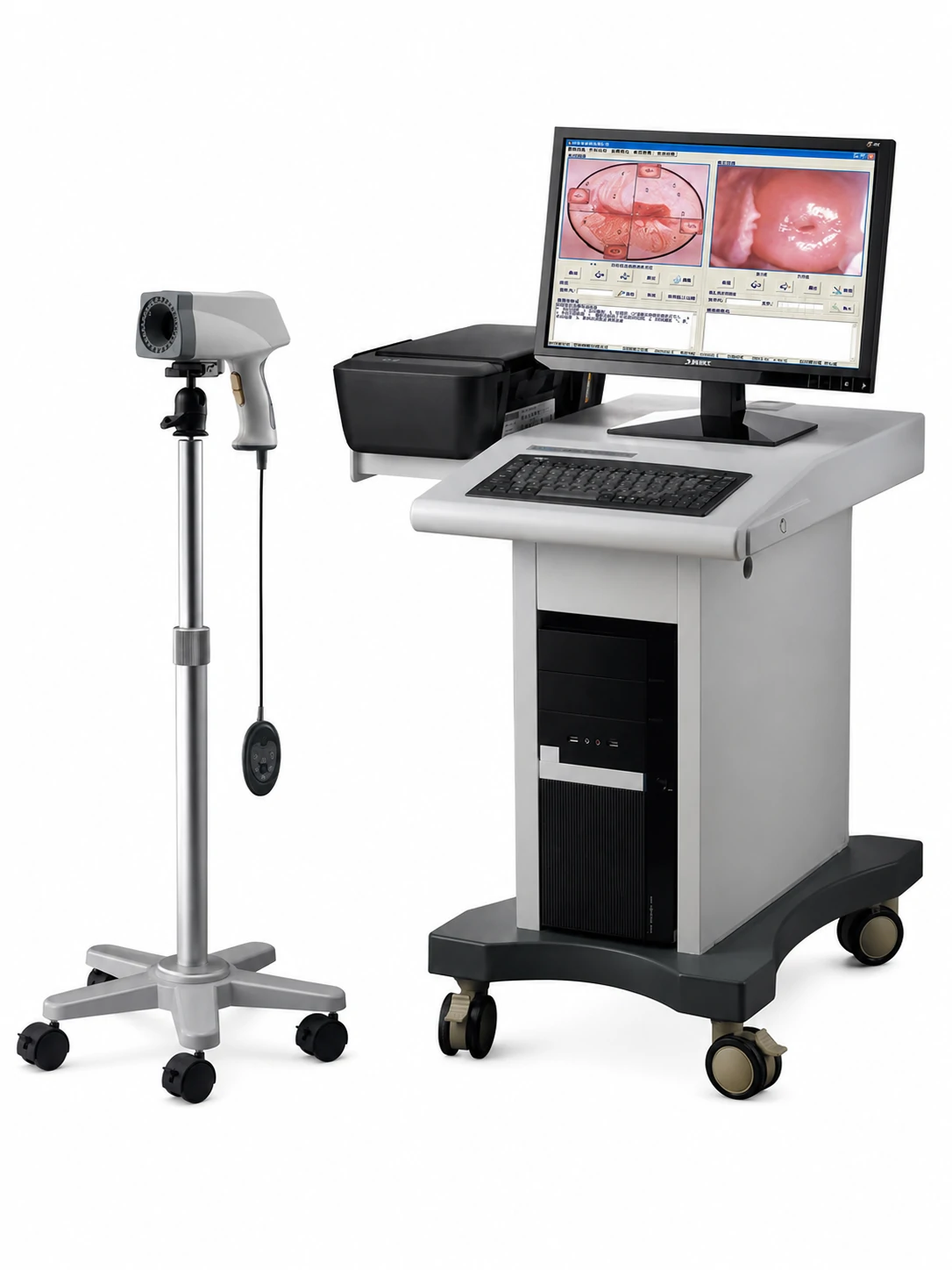 Digital HD Video Colposcope for Gynecology
