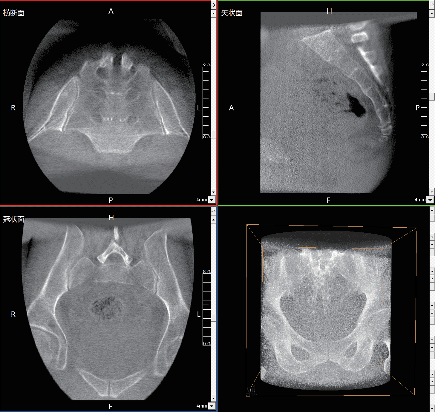 Sacroiliac joints and bilateral sacroiliac screw fixation displayed in a single 3D image from the MCI0423 C-arm.