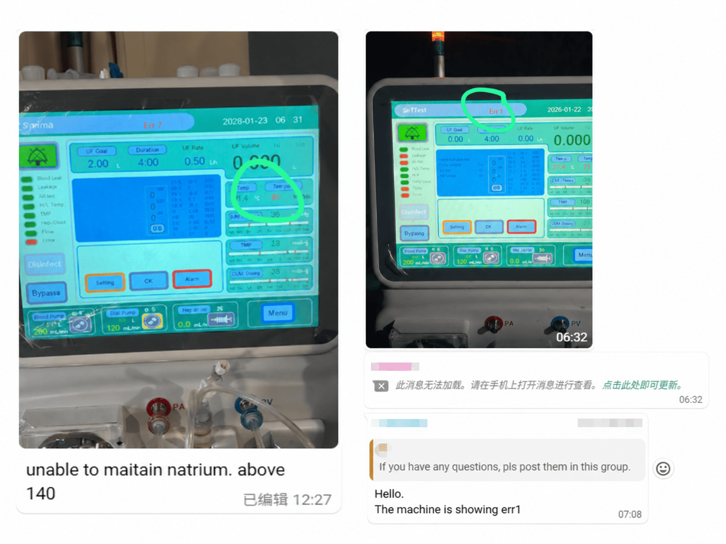 Hemodialysis machine display showing reported errors and a sodium reading concern in South Africa.